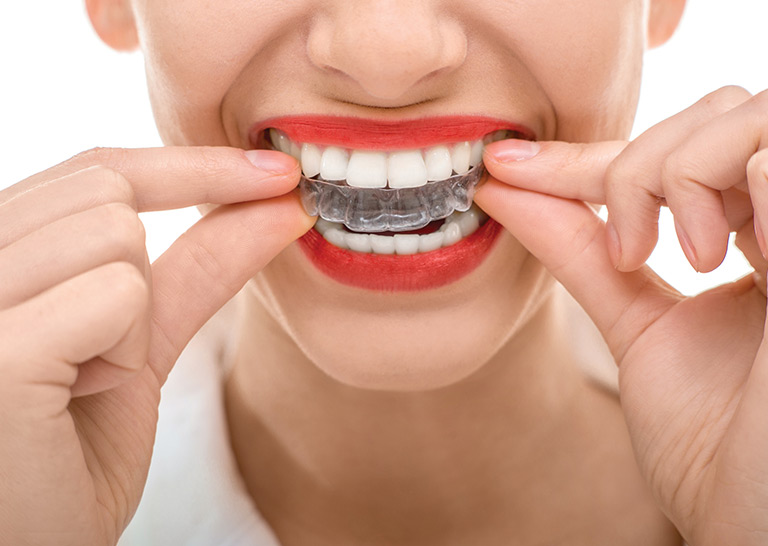 consider-invisalign