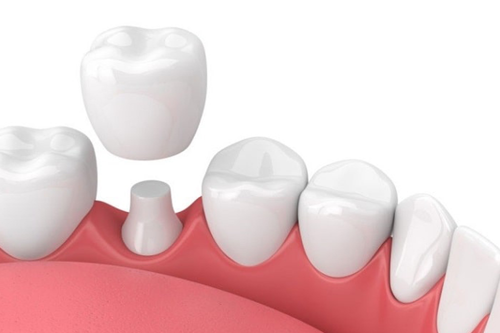 Patient discussing dental crown treatment with dentist in Windsor at Foresto Dentistry