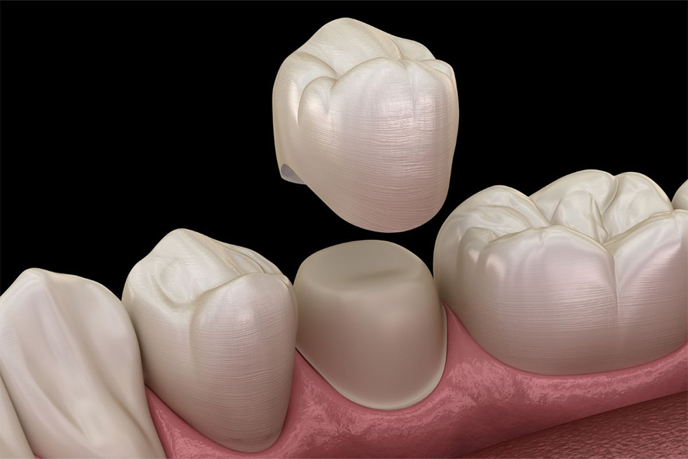 What To Do If a Dental Crown Falls Out